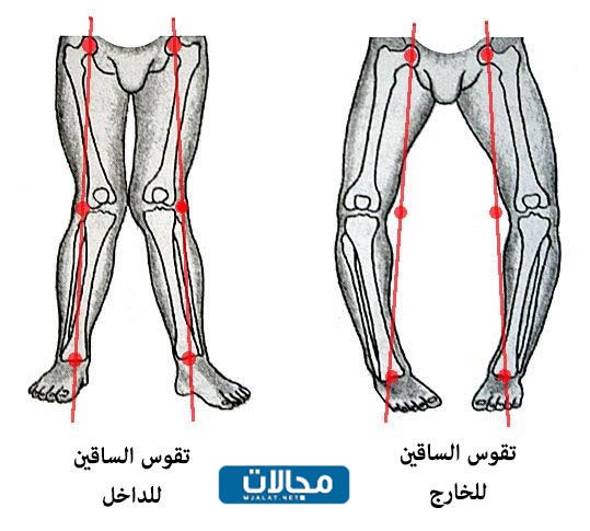 كيف اعرف أن طفلي عنده تقوس في الساقين